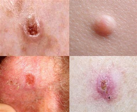 Types Of Skin Cancer
