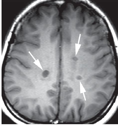 T1 Black Holes In Multiple Sclerosis Axial T1 Weighted Image Shows
