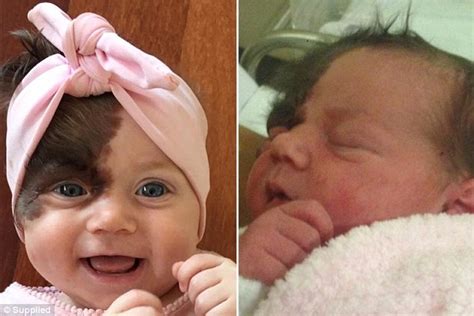 Meet Adorable Baby Born With Dark Birthmark She Will Need 7 Surgeries