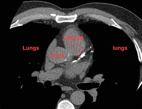 High Heart Calcium CT Scan Score: What to Do Now? Part 2: Joel Kahn, MD