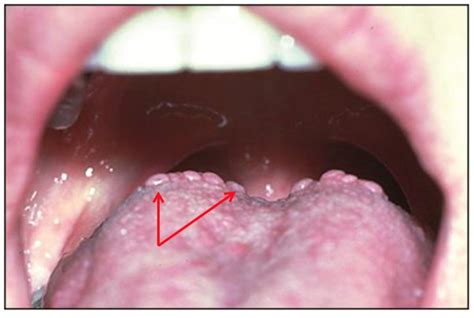 What Causes Painless Bumps On The Back Of My Tongue Quora