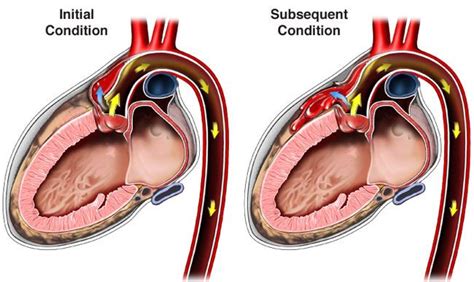 Aortic Dissection Treatment In New Jersey Heart And Vascular Care