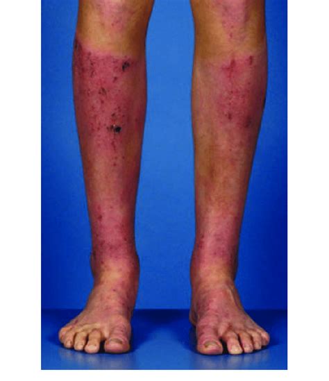 A Boy With Persistent Sharply Demarcated Dermatitis That Appeared On