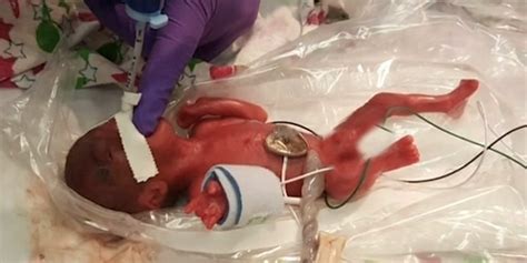 Watch Worlds Smallest Surviving Baby Finally Heads Home