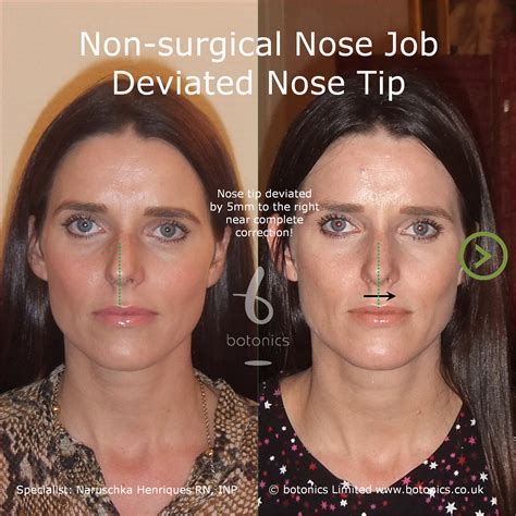 Non Surgical Nose Job Rhinoplasty Clinic Compare My Xxx Hot Girl