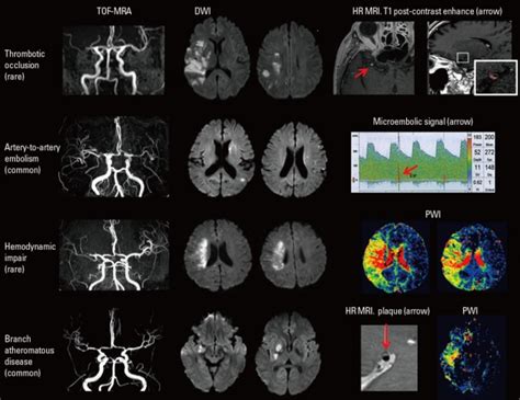 Mechanisms Of Stroke In Patients With Icad A Thrombotic Occlusion Is