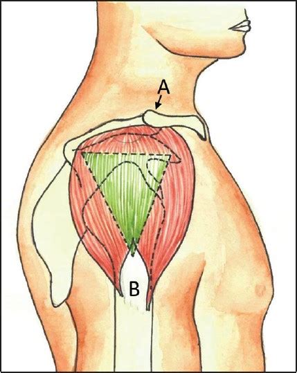 How To Do A Deltoid Injection For Trt Full Guide Demo The Trt Hub