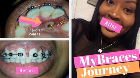 My Two Year Braces Journey Impacted Canine Tooth Youtube
