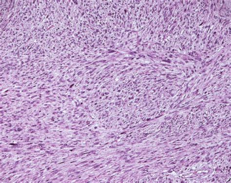 A Case Of High Grade Leiomyosarcoma Of The Bladder With Delayed Onset