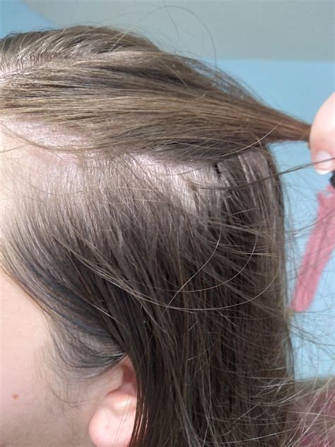 Seborrheic Dermatitis Hair Loss Reversible Minta Covert
