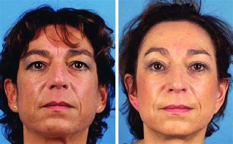 A 46 Year Old Woman Before Left And 46 Months After Right