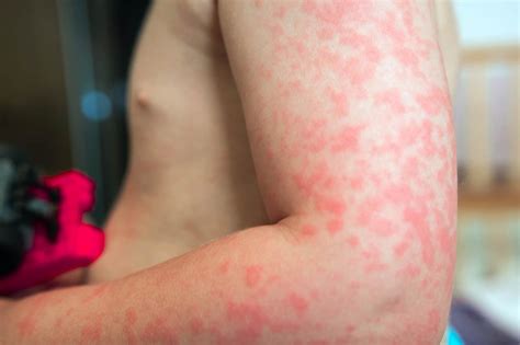 Alergia Pokarmowa Przyczyny Objawy Leczenie I Rodzaje Alergii My Xxx
