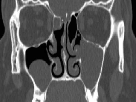 Coronal Ct Scan Shows Asymmetry In The Height Of The Et Open I