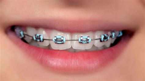 Light Blue Braces Colors Wheel Bdazero