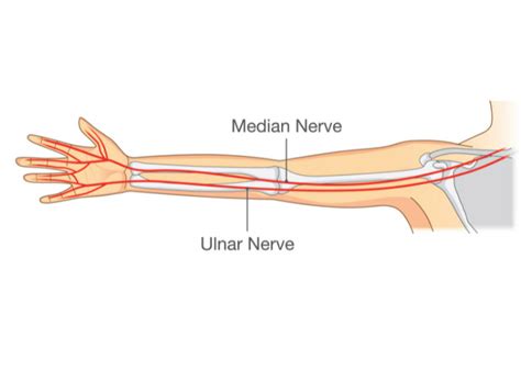 Ulnar Nerve Transposition Pinched Elbow Orthopedic Surgeon