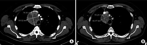 A Computed Tomography Ct Scans Revealed An Approximately 77×64 Cm Download Scientific