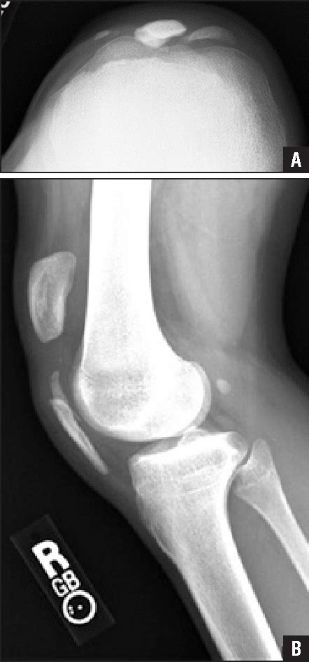 Figure 1 From Patellar Sleeve Fracture With Ossification Of The