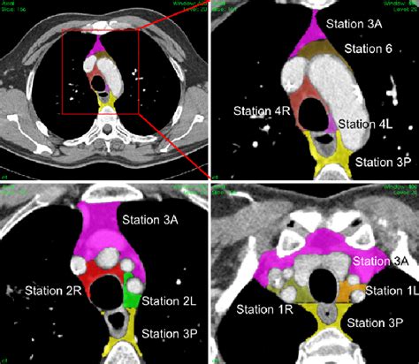 Figure 1 From Investigating Mediastinal Lymph Node Stations
