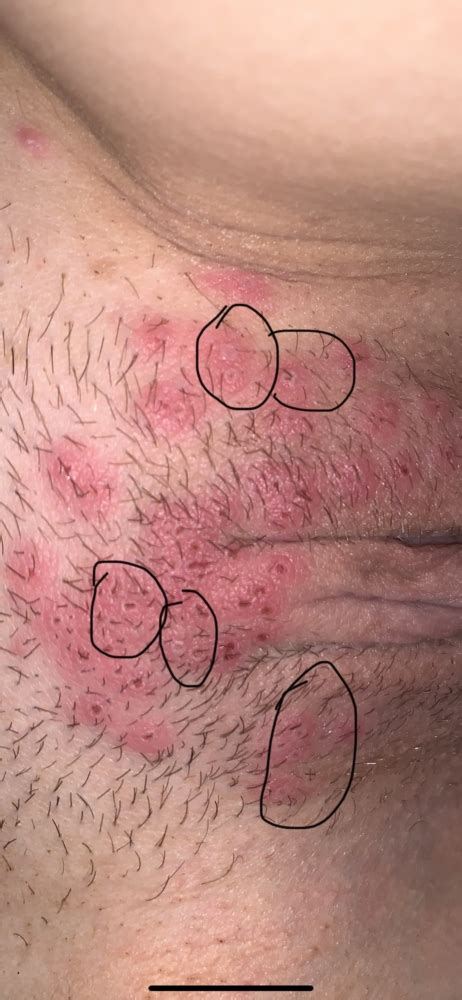 How often do they occur? Dr said this looks like herpes?! | Genital Herpes Simplex ...