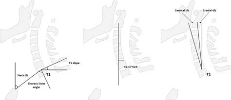 Schematic Drawing Of The Cervical Parameters Measured For The Study