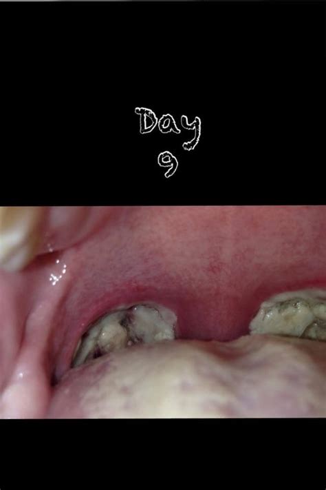 Tonsillectomy Scabs Tonsillectomy Recovery Recovery C