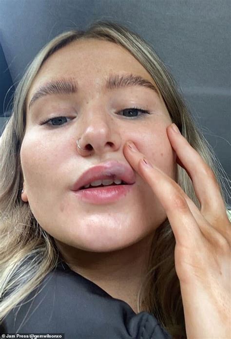 Woman Warns Of Dangers After Nearly Losing Her Lips After Filler Procedure Went Wrong Duk