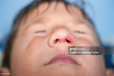 Impetigo Sores That Form In A Wound In The Nose High Res Stock Photo