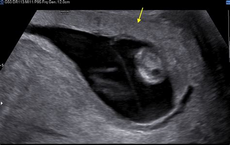 Monochorionic Diamniotic Twin Pregnancy Complicated By Spontaneous