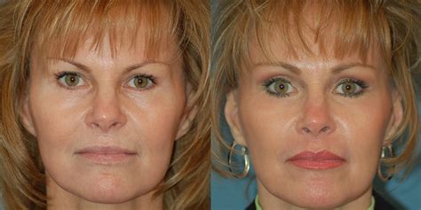 Endoscopic Brow Lift 6 Months Dr Churchill The Center For Facial