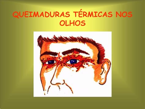 Queimadura De Potó No Olho