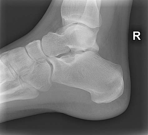 Stress Fracture Calcaneus X Ray Hot Sex Picture