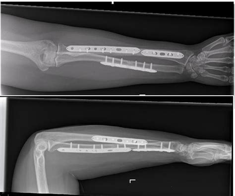 Unilateral, trifocal, diaphyseal fracture of the radius ...