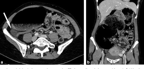 ct findings of cecal volvulus following laparoscopic appendectomy semantic scholar