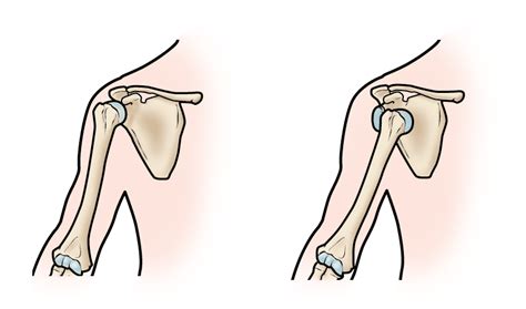 Chronic Shoulder Instability And Dislocation OrthoInfo AAOS
