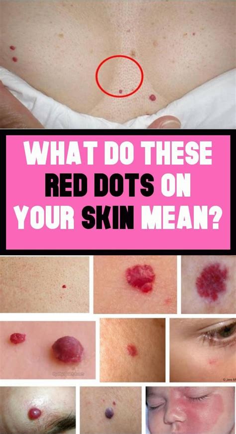 What Do The Red Dots On Your Skin Mean Mean Bodyhealthy