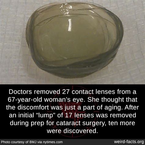 Weird Facts Doctors Removed 27 Contact Lenses From A