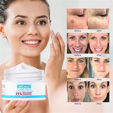 Dark Spot Corrector Face Cream For Melasma Freckle Sun Spot Remover