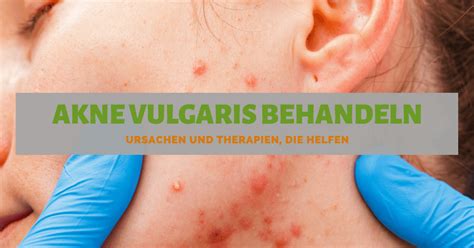 Check spelling or type a new query. Akne Vulgaris behandeln ᐅ Ursachen & Therapien, die Helfen