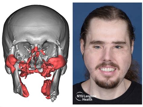 Face Transplant Rebuilds Jaw Teeth And Gums Dentistry Today