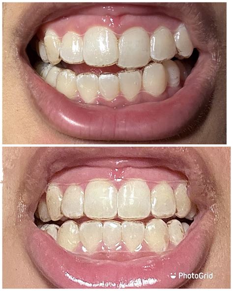 Just Finished My Invisalign Journey Took 19 Trays 15 Refinement Trays Realising Now How