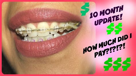 Adult Ceramic Braces Update How Much Did They Cost 5 Youtube