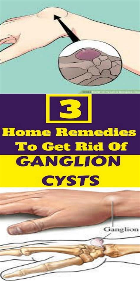 Ganglion Cysts Causes Symptoms Treatment And Exercises Rebalance My Xxx Hot Girl