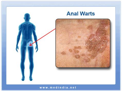 Anal Warts Small