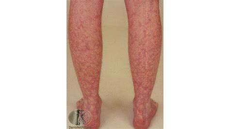 Mottled Skin Livedo Reticularis Causes Signs And Treatment