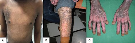 Epidermodysplasia Verruciformis A Study Of Clinicopathologi The American Journal Of