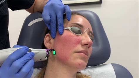 Vbeam Perfecta Pulse Dye Laser Treatment For Facial Redness And Rosacea