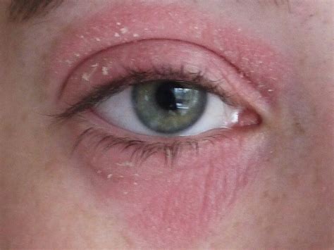 Eczema On Eyelids Causes Symptoms Remedies And Home Treatment Nubo