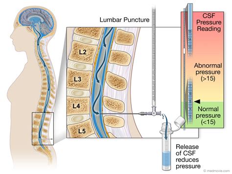 Lumbar Puncture Anatomical Landmarks