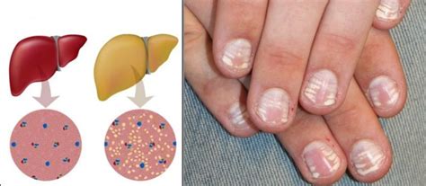 Pellagra is clinically manifested by the 4 d' s: 7 Gründe, warum Sie weiße Stellen auf Ihren Nägeln haben ...