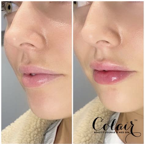 Lip Injections In Gilbert Az Colair Luxury Med Spa